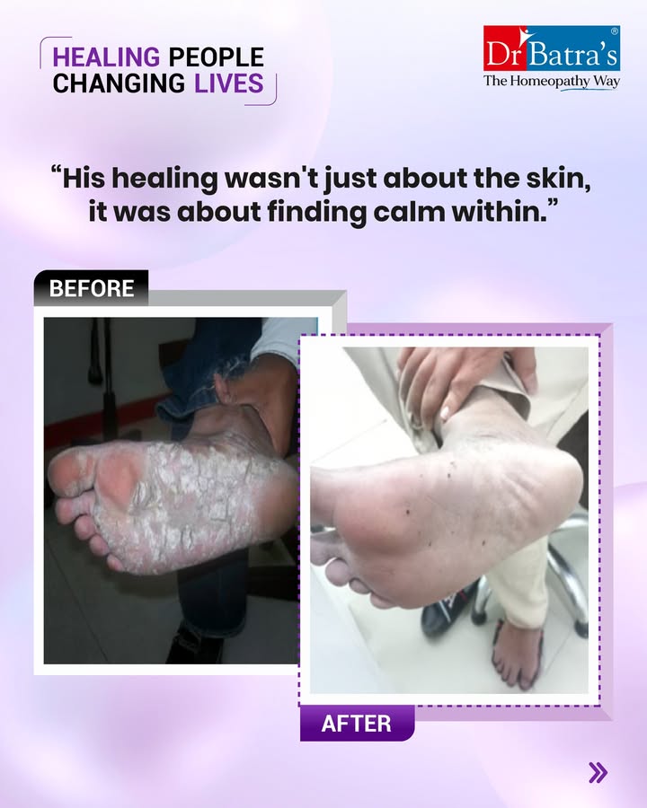 💛 His Hands and Feet Once Hurt — Now, They Heal.
For months, every crack on his palms and soles mirrored his stress and sleepless nights.
No cream or ointment could truly calm the storm within. Every flare-up reminded him of overwork, pressure, and inner restlessness.

Then came a different approach — treatment at Dr Batra’s®, a journey of healing from the inside out.
✨ Homeopathy to calm his mind and body
✨ Remedies to balance immunity and soothe inflammation
✨ Lifestyle guidance for rest and recovery
✨ Gentle emotional support to rebuild confidence

And within just 3 months, transformation began…
🌿 Itching and scaling reduced
🌿 Cracks began to heal
🌿 Skin started regaining its smoothness
🌿 Sleep and calmness returned
🌿 Confidence grew with every clear patch

It wasn’t just his skin that healed — it was his peace, his rest, his self-belief.
Because true healing isn’t just skin-deep — it’s peace-deep. 💛

📞 Call: +91 91671 91671
🌐 Book now: drbatras.com/skin-diseases/psoriasis-treatment-in-homeopathy
📲 Follow @drbatras_healthcare for more inspiring healing stories.
#AbJeetoJaddSe

#HealingPeopleChangingLives #DrBatras #DrBatrasHealthcare #Psoriasis #PsoriasisRelief #SkinHealing #MindSkinConnection #TrueHealingInsideOut #HomeopathyWorks #ConfidenceRestored #EmotionalHealing #TheHomeopathyWay #BanjarahillsClinic