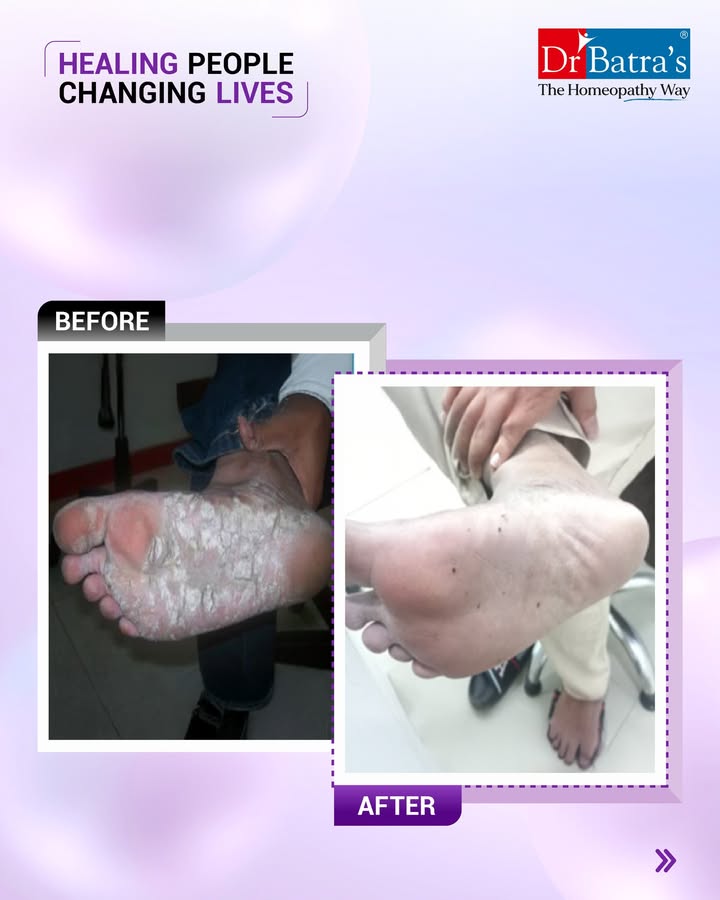 💛 His Hands and Feet Once Hurt — Now, They Heal.

For months, every crack on his palms and soles mirrored his stress and sleepless nights.
No cream or ointment could truly calm the storm within. Every flare-up reminded him of overwork, pressure, and inner restlessness.

Then came a different approach — treatment at Dr Batra’s®, a journey of healing from the inside out.
✨ Homeopathy to calm his mind and body
✨ Remedies to balance immunity and soothe inflammation
✨ Lifestyle guidance for rest and recovery
✨ Gentle emotional support to rebuild confidence

And within just 3 months, transformation began…
🌿 Itching and scaling reduced
🌿 Cracks began to heal
🌿 Skin started regaining its smoothness
🌿 Sleep and calmness returned
🌿 Confidence grew with every clear patch

It wasn’t just his skin that healed — it was his peace, his rest, his self-belief.
Because true healing isn’t just skin-deep — it’s peace-deep. 💛

📞 Call: +91 91671 91671
🌐 Book now: drbatras.com/skin-diseases/psoriasis-treatment-in-homeopathy
📲 Follow @drbatras_healthcare for more inspiring healing stories.
#AbJeetoJaddSe

#HealingPeopleChangingLives #DrBatras #DrBatrasHealthcare #Psoriasis #PsoriasisRelief #SkinHealing #MindSkinConnection #TrueHealingInsideOut #HomeopathyWorks #ConfidenceRestored #EmotionalHealing #TheHomeopathyWay #BanjarahillsClinic