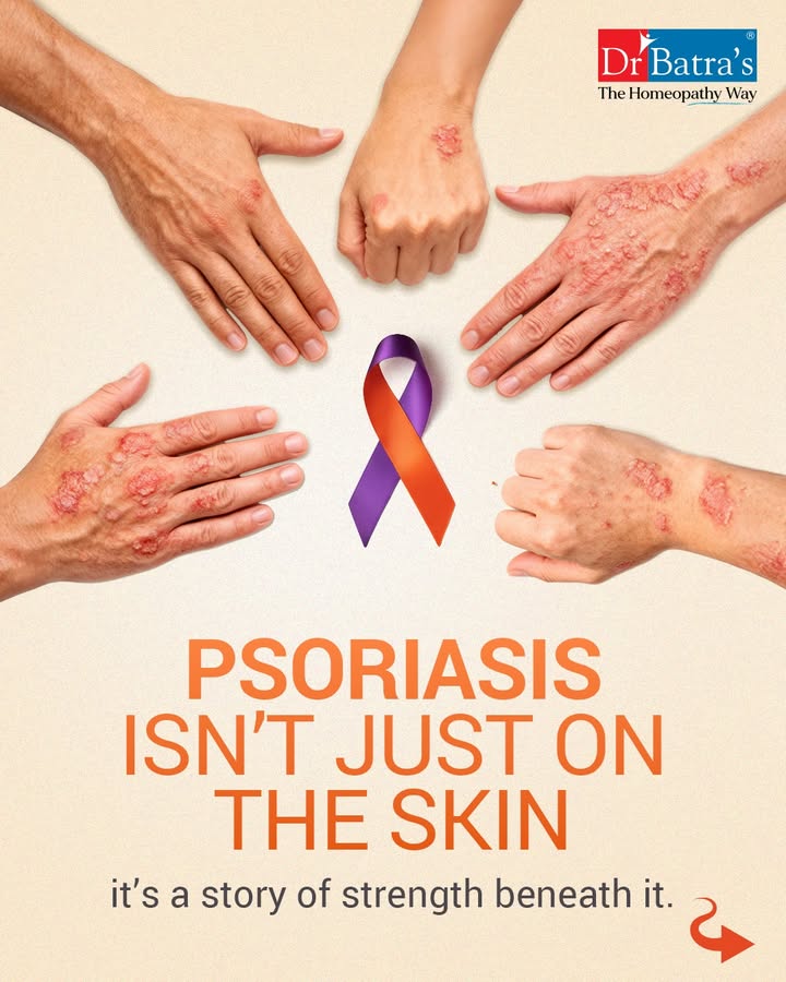 What we see on the surface is only part of the story.
Behind every patch of Psoriasis lies patience, courage, and a will that refuses to give up.

At Dr Batra’s®, we believe healing begins when compassion meets care — from within.
Through gentle, personalised Homeopathy treatments, we help strengthen immunity, calm inflammation, and restore confidence — one story at a time.

This #WorldPsoriasisDay, let’s break the stigma, replace judgment with understanding, and stand together for a world where every skin feels accepted. 💙

Because healing isn’t just skin deep — it’s human deep.

🌿 Begin your journey to healthier skin today.
📞 Call: +91 91671 91671
🌐 Visit: www.drbatras.com


.
.
#DrBatras #DrBatrasHealthcare #WorldPsoriasisDay #Topical #Celebrating #HealingBeginsHere #HealingWithCare #HomeopathyHeals #PsoriasisAwareness #CompassionInCare #SkinHealth #HealingFromWithin #WorldPsoriasisDay2025 #HealthySkinJourney #BecauseYouMatter #HomeopathyHealing #NaturalCare #NoSideEffects #SkinTreatment #PsoriasisTreatment